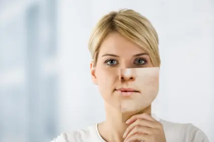 Acne Scarring and Rosacea