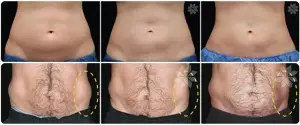 Coolsculpting before and after, Fat freezing before and after treatment in Cardiff, Wales, London, England