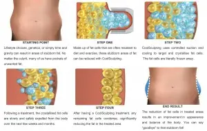 Freeze Away Stubborn Fat With the CoolSculpting Fat Reduction or Fat Removal treament in Cardiff, Wales, London, England.