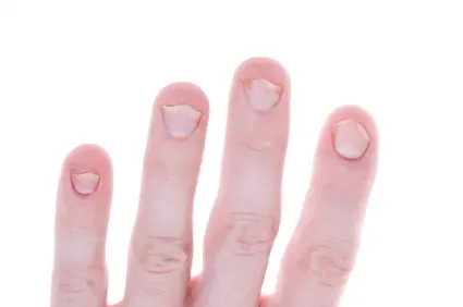 Finger Nail Infections Cardiff