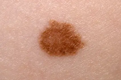Mole Check Clinics