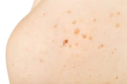 Chemical peel treatments London