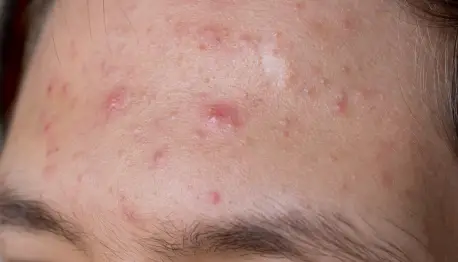 Acne treatments cardiff stoke poges london aylesbury milton keynes