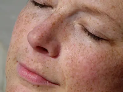 Facial Pigmentation Treatments