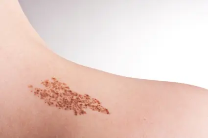 Birthmark Treatments Cardiff
