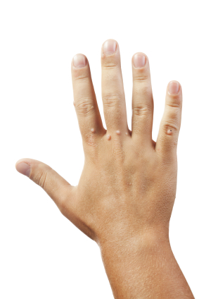 Wart treatments Cardiff, newport caerphilly south wales